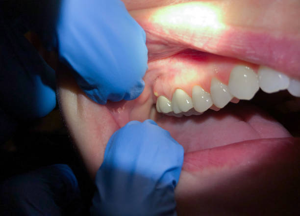Best Emergency Dentist for Knocked-Out Tooth in Pilot Mountain, NC